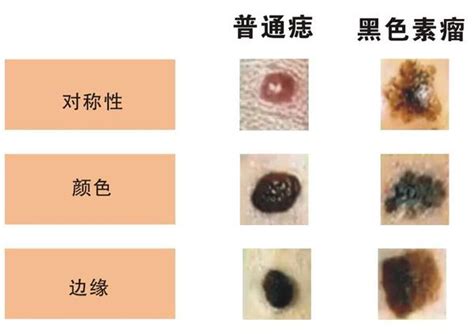 不規則黑痣|是痣還是瘤？黑色素瘤的類型、症狀與治療